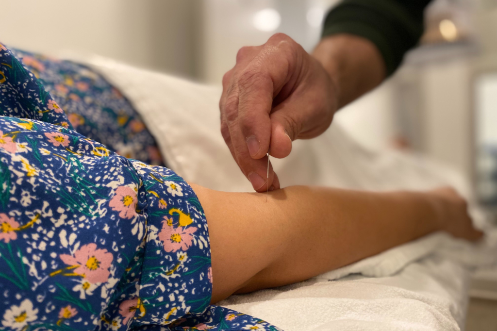 Acupuncture
